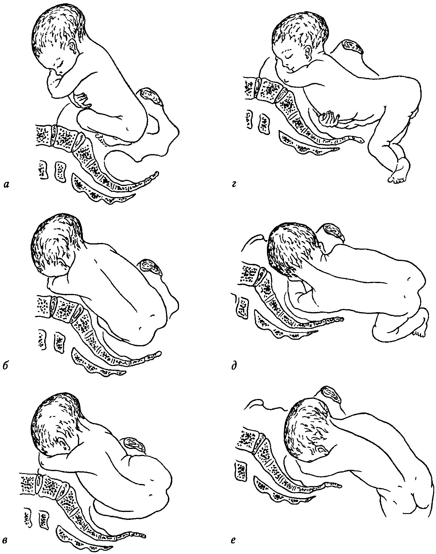 Тазовое предлежание плода биомеханизм родов. Тазовое предлежание плода биомеханизм. Билмеханизм родов при тащовос предледании. Биомеханиз родов при тазовом предложении. Роды по горизонтали