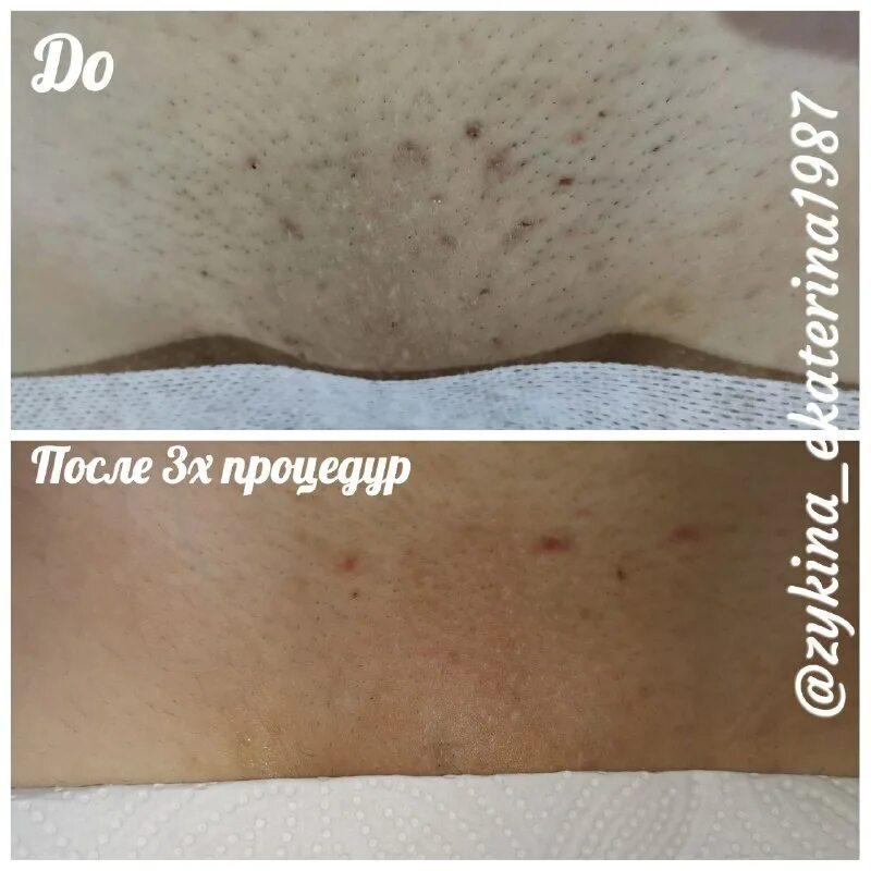 после лазерной эпиляции. лазерная эпиляция зоны бикини. лазерная эпиляция результат. волосы после лазерной эпиляции. лазерная эпиляция после первой процедуры.