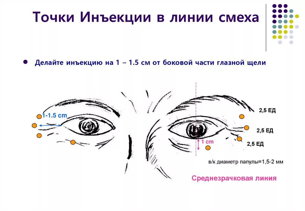 Ботуоакс схема введения. Схема введения ботулотоксина в лицо. Ботокс схема введения. Точки введения ботокса. Точка уколова