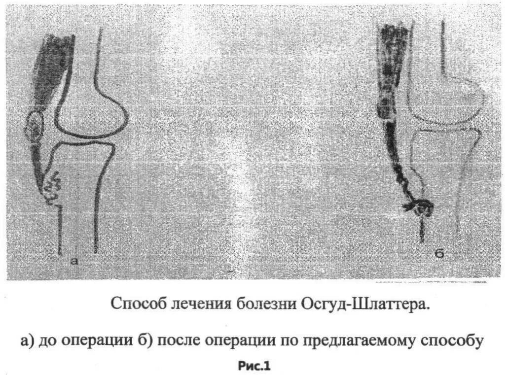 Болезнь осгуда шлаттера код мкб 10. Синдром шляттера осгуда. осгуд шляттера операция. болезнь осгуда шлаттер. осгуд шляттера хирургия.