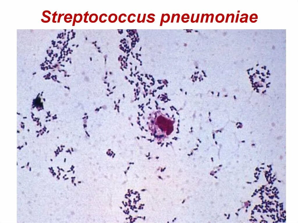 Пневмония streptococcus pneumoniae