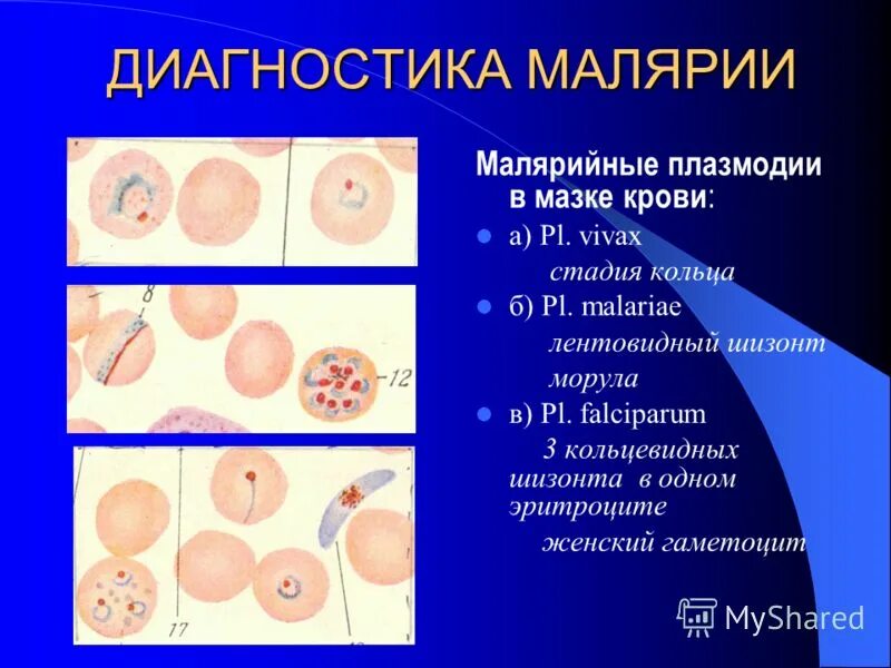 Кровь на малярию. Диагностика малярии. Малярийный плазмодий. Малярийный плазмодий диагностика. Диагностические стадии плазмодия.