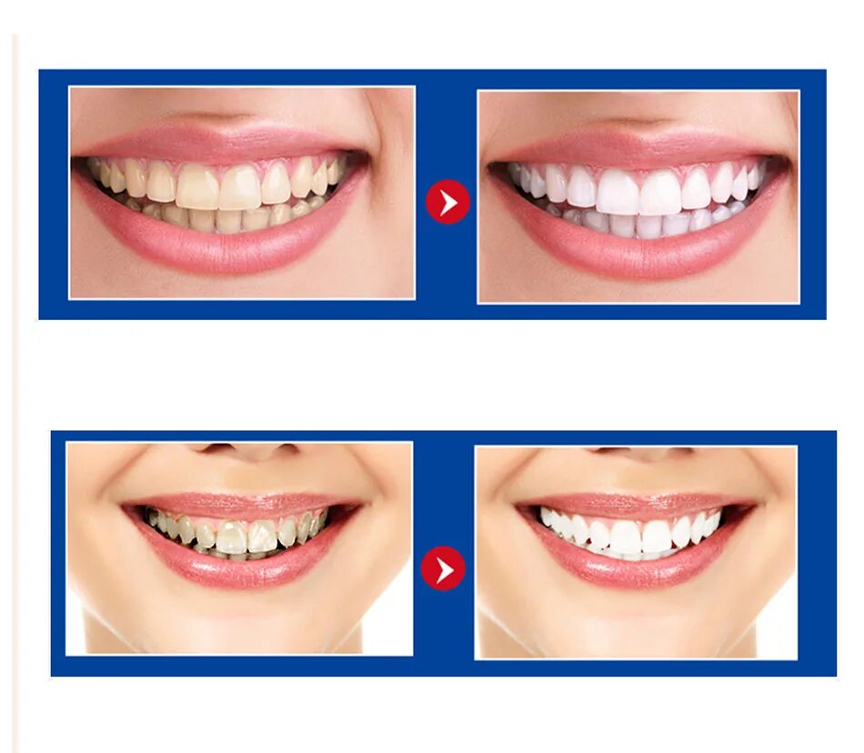 Отбеливание зубов до и после. Диета после отбеливания зубов. Белая диета после отбеливания зубов. Отбеливание черные зубы после отбеливания.