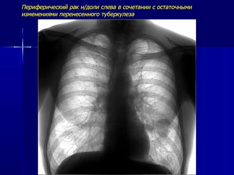 Периферическое образование левого легкого. Опухоль в легких на рентгене. Периферическое образование легкого рентген. Периферическое образование левого легкого рентген. Центральное образование легкого рентген.