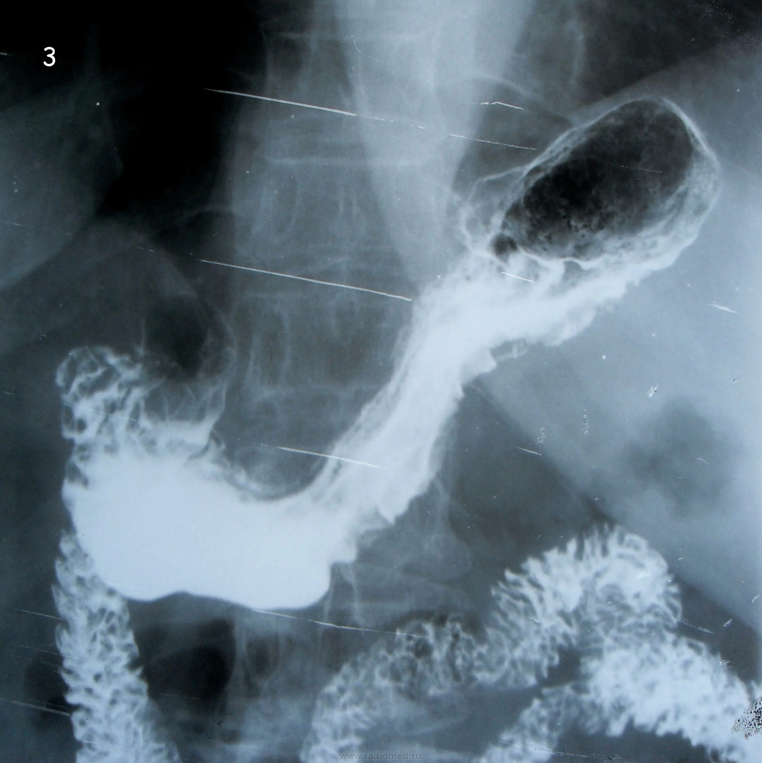 Рентгеноскопия. Цифровая рентгеноскопия кишечника и желудка. 2. Рентгеноскопия желудка.