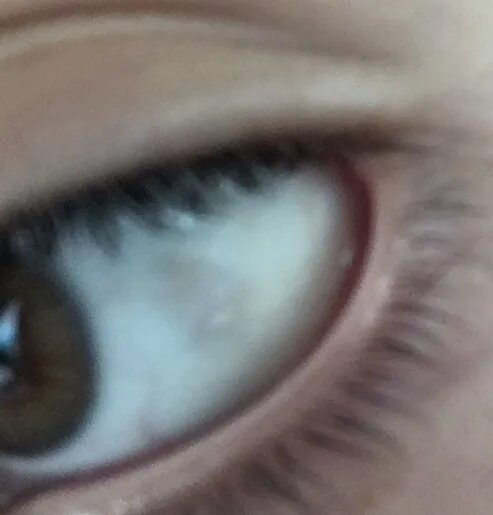 черные пятна на глазном яблоке. коричневая точка на белке глаза. на глазах белка темные пятна. темное пятно на белке глаза. темное пятно на белке глаза.