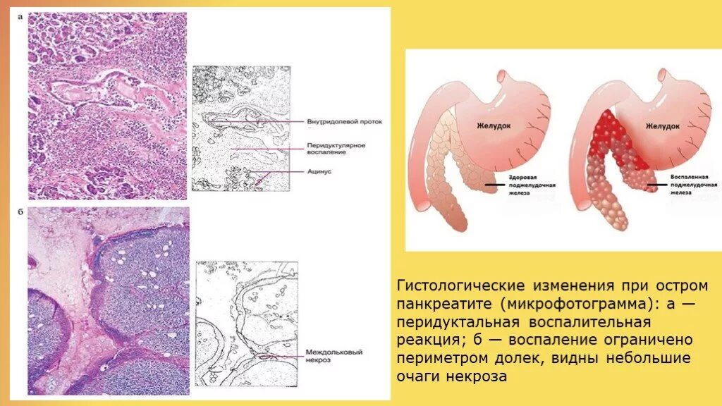 Фиброзные изменения поджелудочной