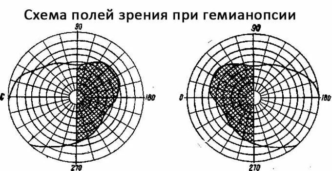 Исчезнуть из поля зрения бывшей. Схема поле зрения периметрия. схема зрительных полей. схема выпадения полей зрения. поля зрения гемианопсия.