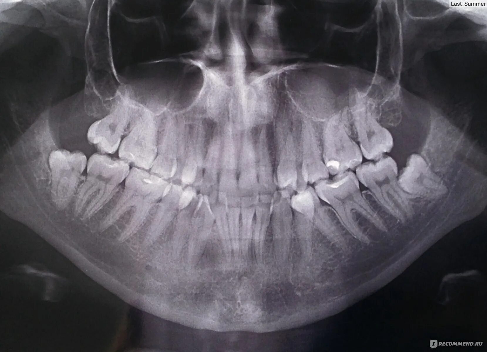 Зуб 8 нижний. Ретинированный дистопированный зуб мудрости. Ретинированный зуб мудрости снимок. Ретинированный зуб мудрости рентген. Ретинированный клык верхней челюсти.