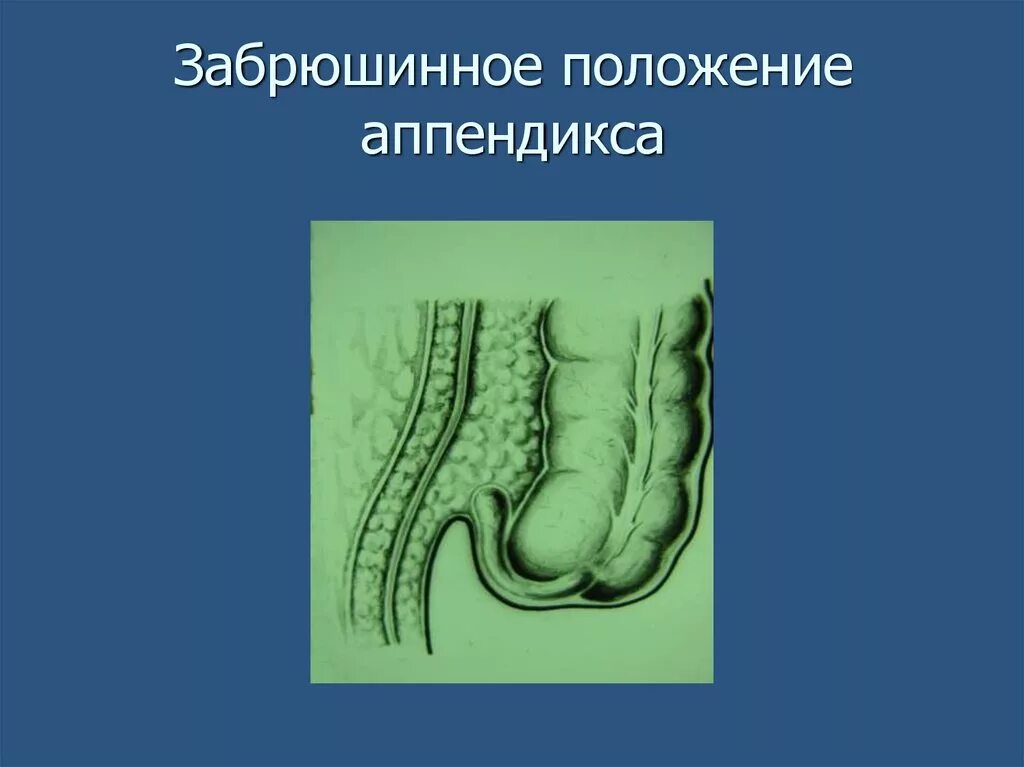 Аппендикс червеобразный. Ретроцекальный аппендицит. Ретроцекальная аппендэктомия. Ретроперитонеальное расположение аппендицита. Ретроцекальный острый аппендицит.