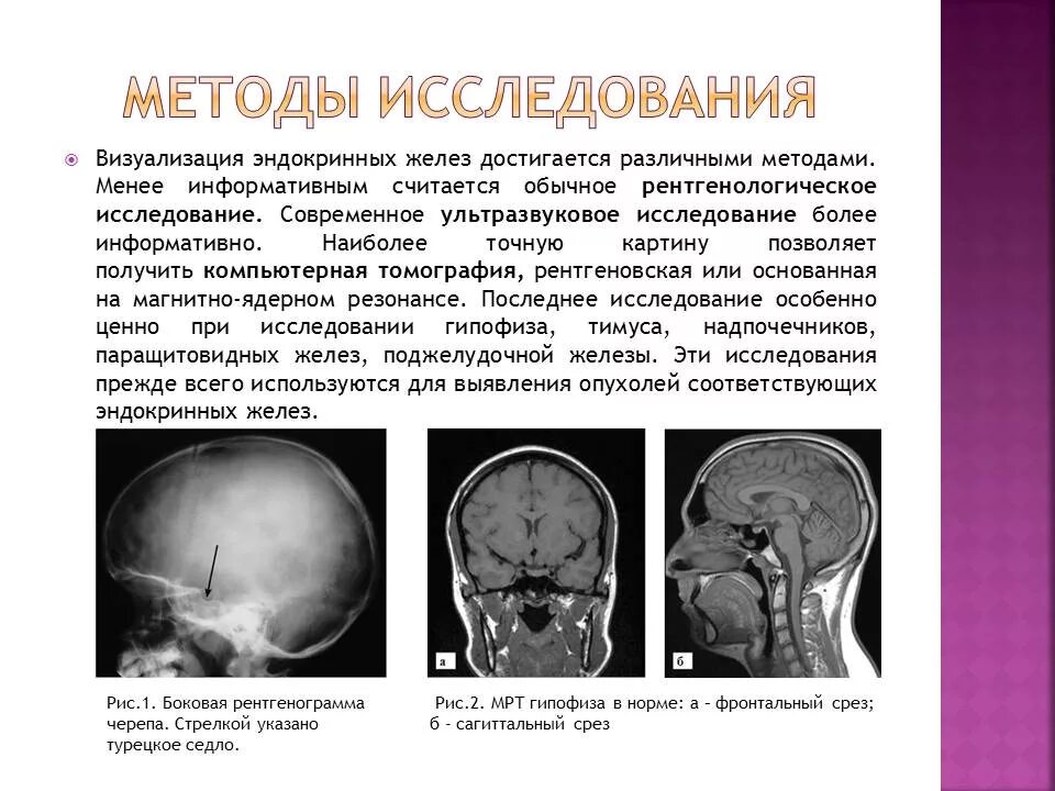 Аденома гипофиза рентген черепа. Лучевая диагностика турецкого седла. Синдром пустого турецкого седла кт. Анатомия турецкого седла рентген.