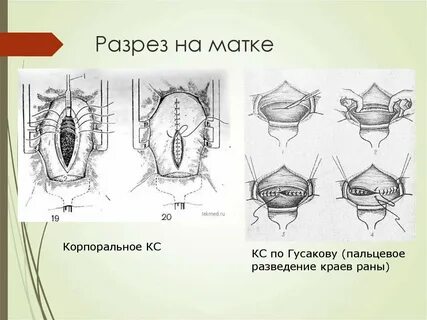 Виды кесаревом сечении