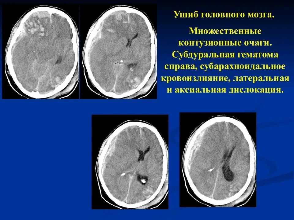 Что значит очаг в головном мозге. Контузионные очаги типы кт. Контузионные очаги 1 типа кт. Очаги ушиба головного мозга на кт. Контузионные очаги головного мозга на кт.