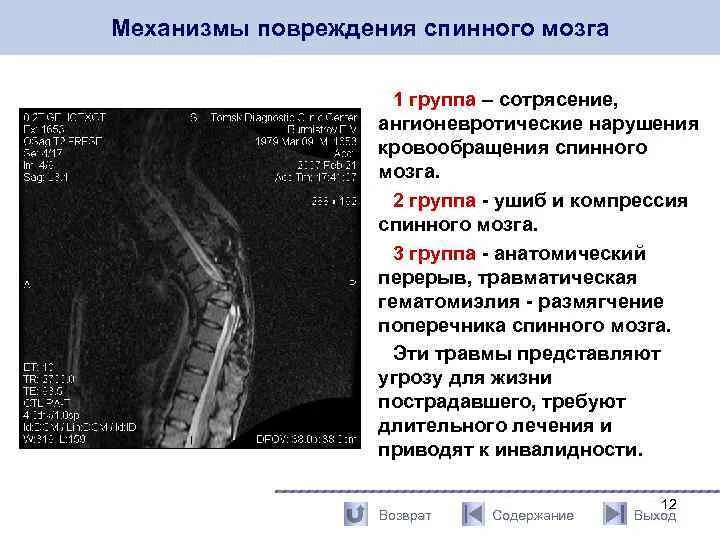 Сотрясение спинного. Механизм повреждения спинного мозга. Травматические повреждения спинного мозга. Сотрясение спинного мозга. Таблица травмы спинного мозга.