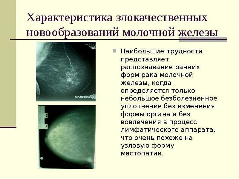 Доброкачественная опухоль молочной железы на узи. Новообразование молочной железы фиброаденома. Опухоль молочной железы на узи. Фиброзно-кистозная мастопатия маммография. Нашли новообразование в молочной железе.