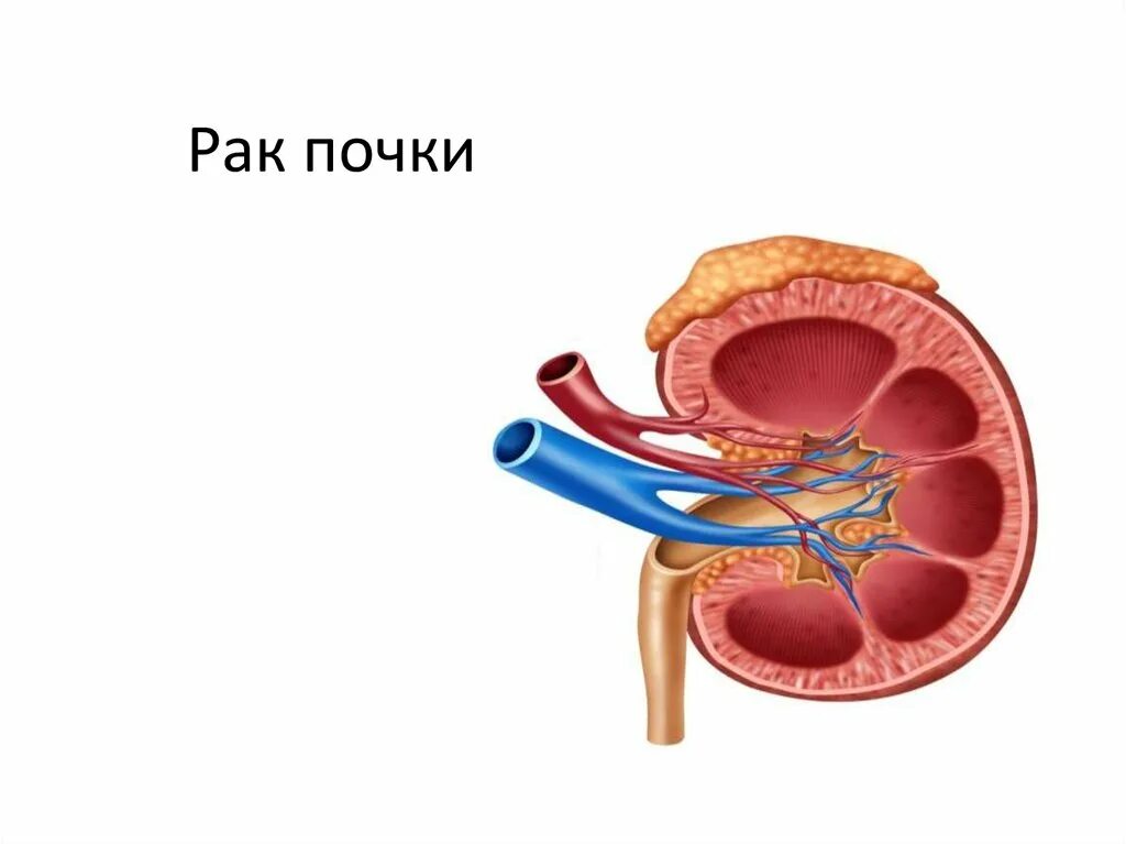 Почечно клеточная карцинома. Почка. Рак почки причины