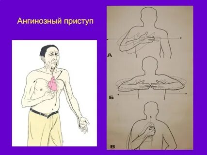 Ангинозный приступ стенокардии