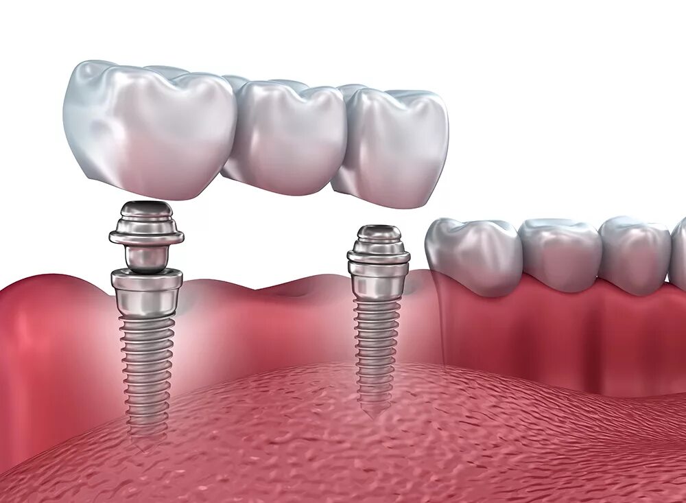 Мостовидный протез на 4 имплантах. Мостовидный протез на имплантатах. Имплант зуба абатмент.