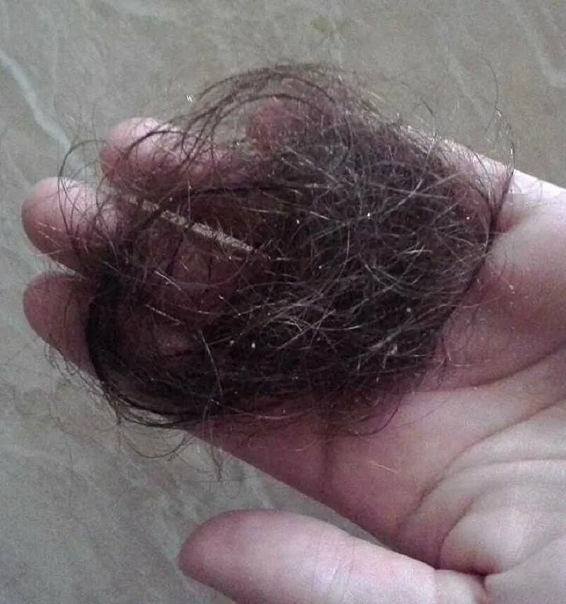 Сколько волос есть у человека. Выпадение волос. Сотное выпадение волос.