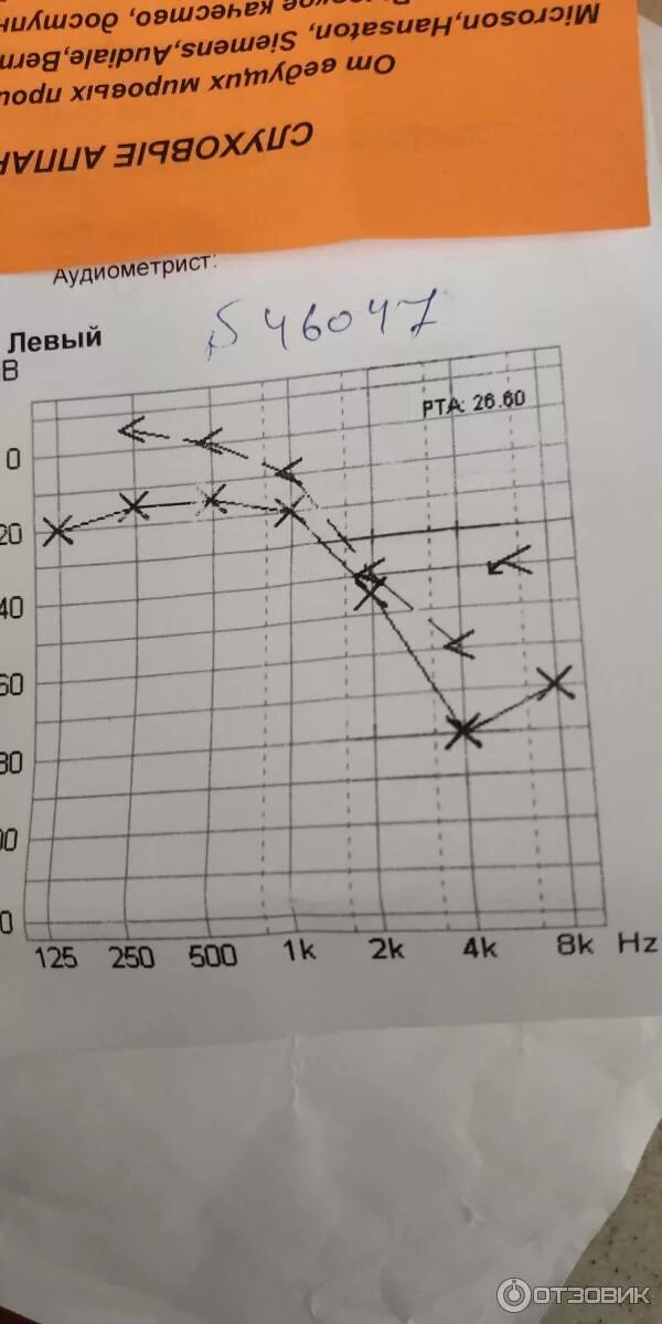 Аудиограмма степени. Кондуктивная тугоухость 1 степени аудиограмма. Аудиограмма 3 степени тугоухости. Аудиограмма нейросенсорной тугоухости 1 степени. Аудиограмма 4 степени тугоухости.