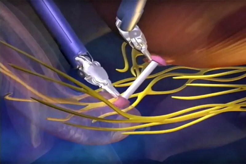 Робот ассистированная простатэктомия. Лапароскопическая простатэктомия. Нервосберегающая простатэктомия. Пейсмейкер лапароскопическая простатэктомия. Да винчи операция простата