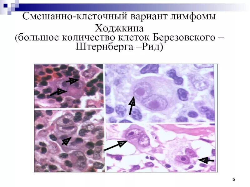 История лимфомы. Клетки Ходжкина гистология. Лимфома Ходжкина гистология. Клетки Рид-Березовского-Штернберга. Крупноклеточная лимфома гистология.