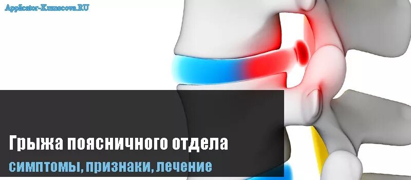 Грыжа поясничного отдела лечение у мужчин симптомы. Признаки грыжи в поясничном отделе. Грыжа поясничного отдела лечение. Грыжа поясничного отдела отдает в ногу. Межпозвоночная грыжа поясничного отдела отдает в ногу.