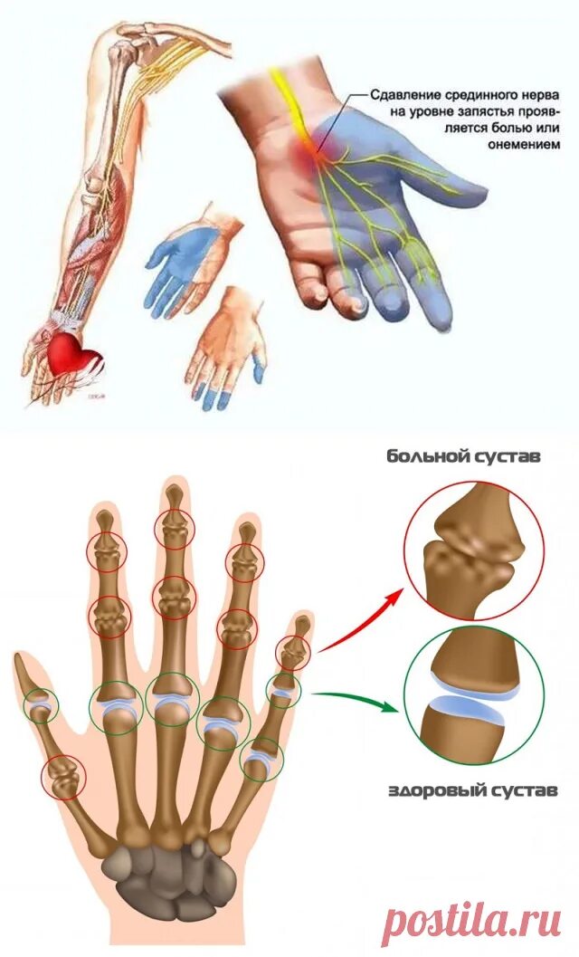 Почему немеет большой палец на правой руке. Немеют руки. Болит рука и немеют пальцы. Болит кисть немеют пальцы.