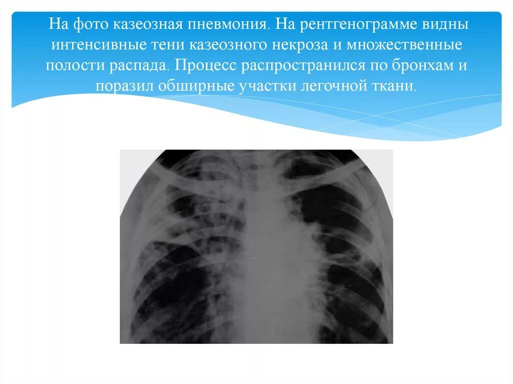 Незначительная пневмония. Незначительная пневмония. Причины развития пневмонии. Заболевание пневмония легких. Патогенез внебольничной пневмонии.