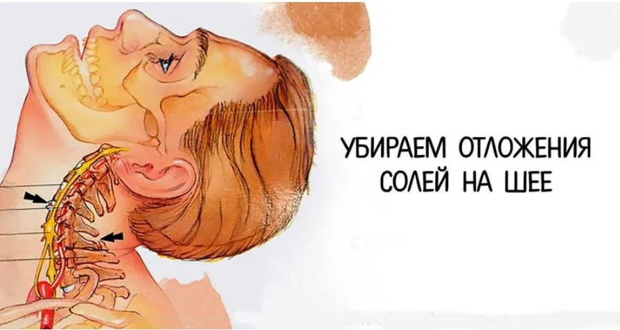 Избавится от солей. Отложение солей в шейном отделе симптомы. упражнения при отложения солей на шее. отложений солей на шее избавление. отложение солей на шее схема.