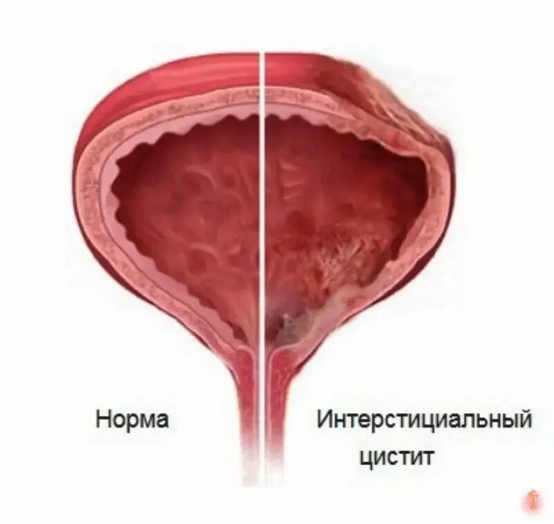 Хронический цистит гистология. Хронический интерстициальный цистит. Интерстициальная ткань мочевого пузыря. Интерстициальный цистит цистоскопия. Можно греть мочевой