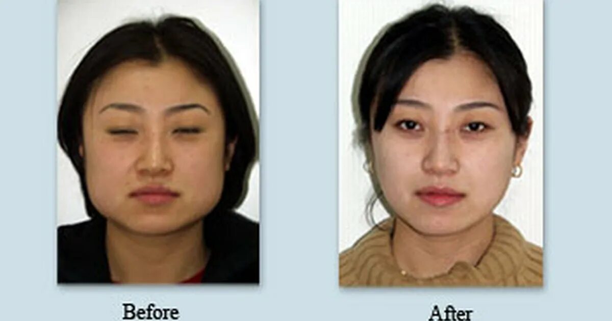 диспорт в жевательные мышцы. дисплри в жевательные мышцы. ботокс в челюсть. гипертонус жевательных мышц ботоксом. расслабление жевательных мышц ботоксом.