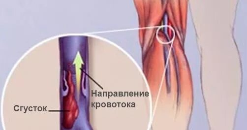 Постинъекционный тромбофлебит. Тромбофлебит кубитальной вены. Флебит и тромбофлебит вен нижних конечностей. Тромбофлебит вен мкб