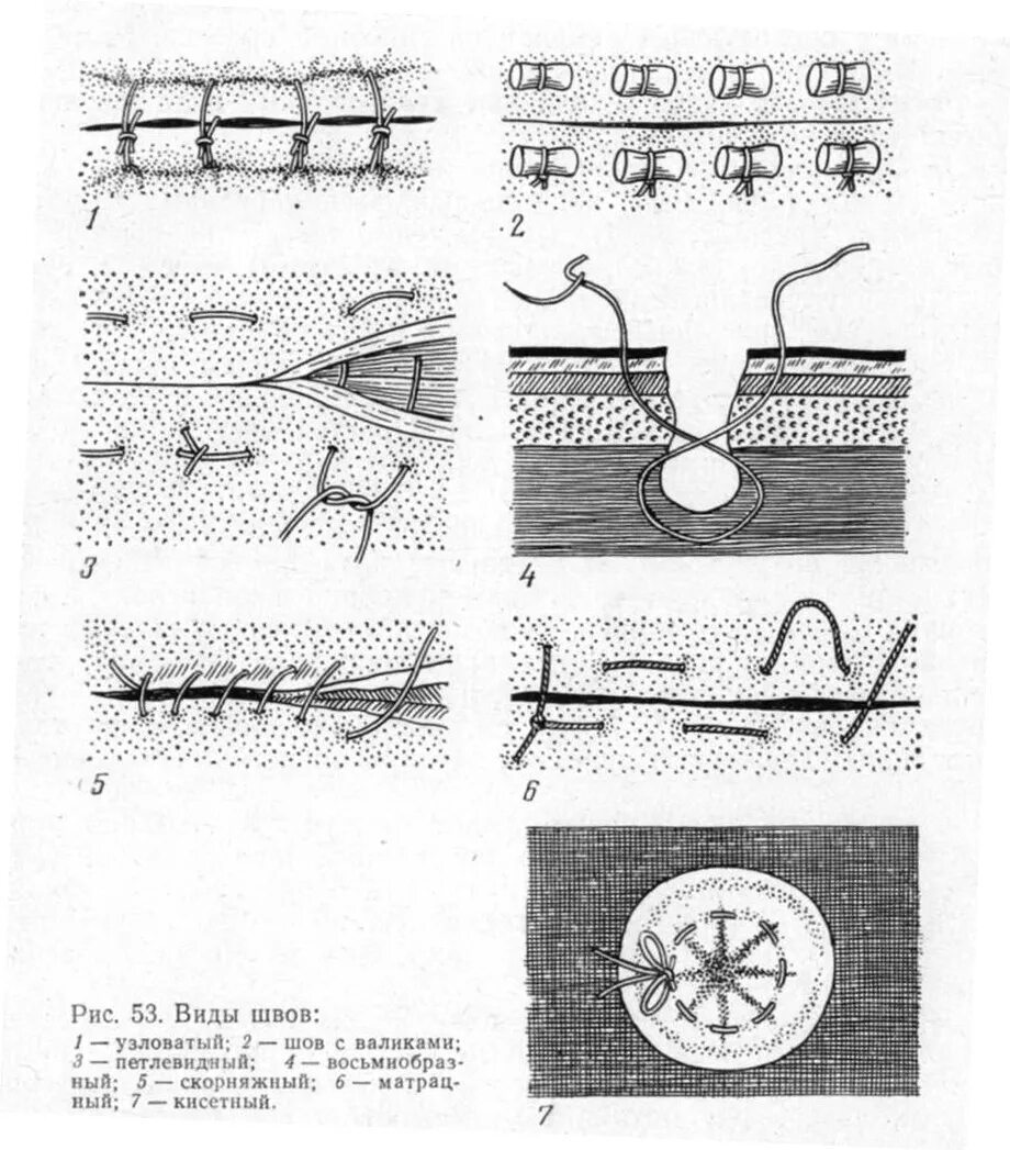 Техника наложения хирургических швов. Узловой шов Ветеринария. Наложение хирургических швов Ветеринария. Петлевидный шов хирургия. Скорняжный шов хирургия Ветеринария.