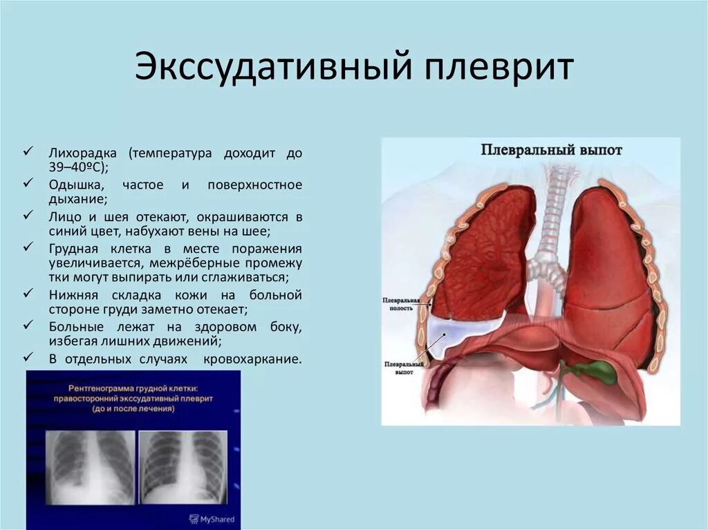 Основной симптом экссудативного плеврита. Что такое экссудативный плеврит лёгких. Плеврит осложненный гидротораксом. Плевральные осложнения