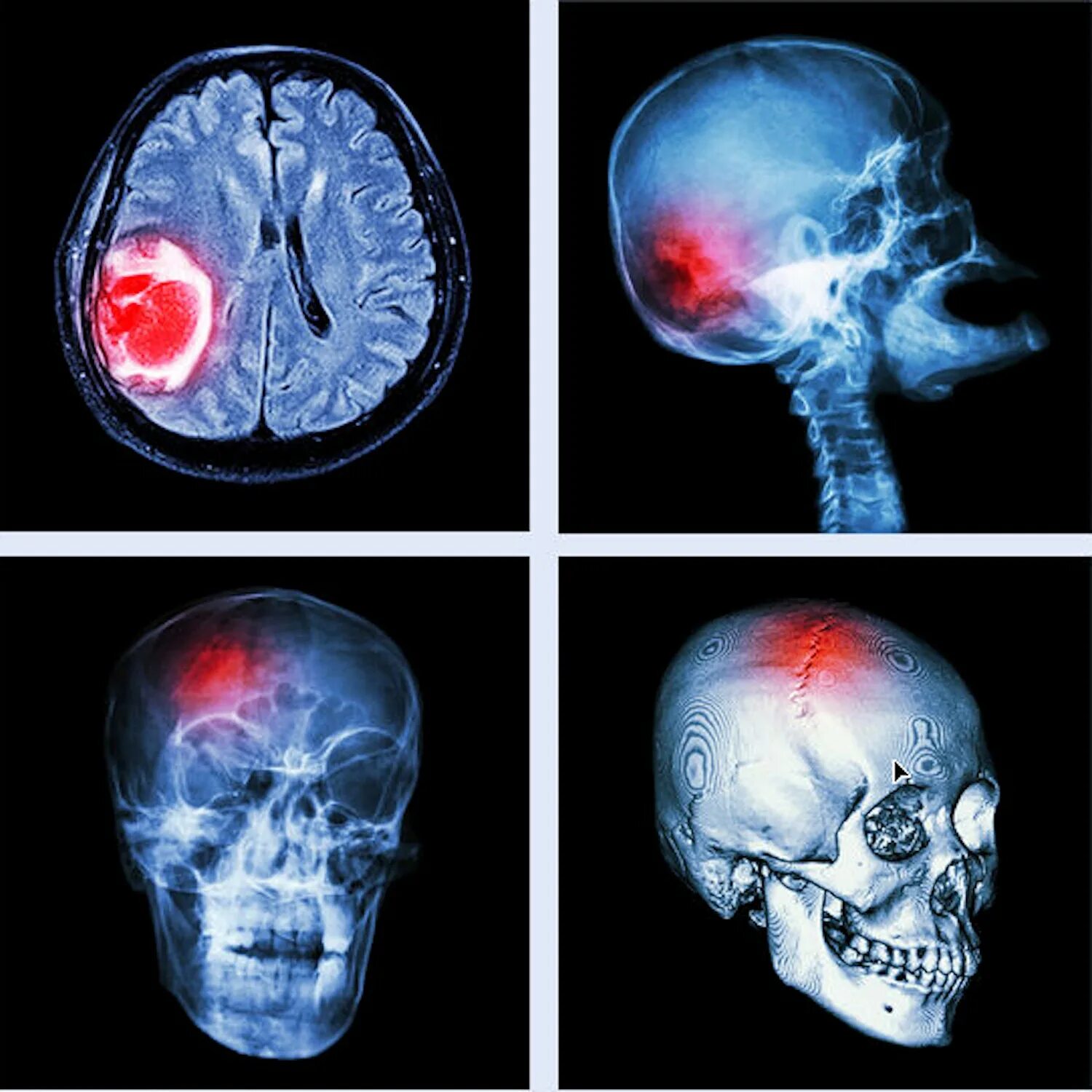 Перелом основания черепа ОЧМТ или ЧМТ. Черепно-мозговая травма рентген. Перелом черепа головного мозга. Открытый перелом основания черепа. Травмы черепа и головного мозга