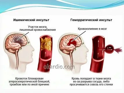 Инсульт отзывы врачей