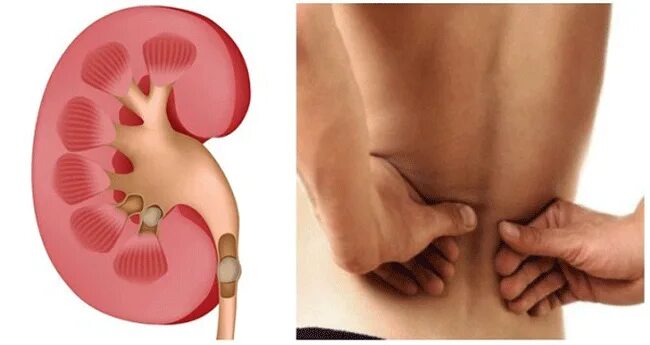 Органы человека почки. Конкременты в почках солевые. Кристаллы мочевой кислоты в почках. Почки человека фото анатомия. Мочекаменная болезнь конкременты.