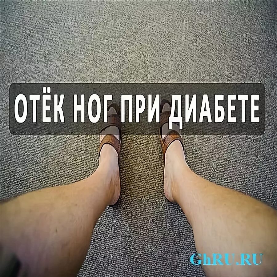отекают ноги при сахарном диабете 2. отекают ноги при сахарном диабете 2. отекают ноги при сахарном диабете 2. отекают ноги при сахарном диабете 2. отекают ноги при сахарном диабете 2.