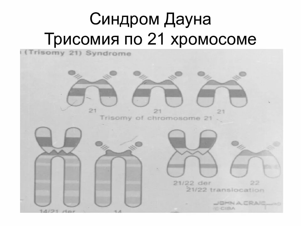 Синдром Дауна хромосомы. Синдром Дауна 21 хромосома. Наследование синдрома Дауна схема. Набор хромосом у человека с синдромом Дауна. Синдром дауна механизм