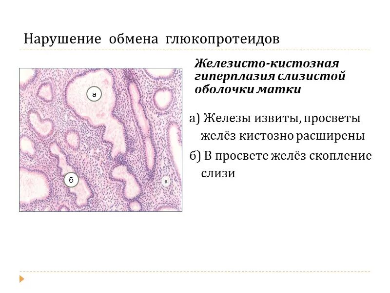 Кистозно расширенная железа. Железисто-кистозная гиперплазия гистология. Железисто-кистозная гиперплазия эндометрия микропрепарат. Гиперплазия эндометрия микропрепарат. Железистая гиперплазия слизистой оболочки матки макропрепарат.