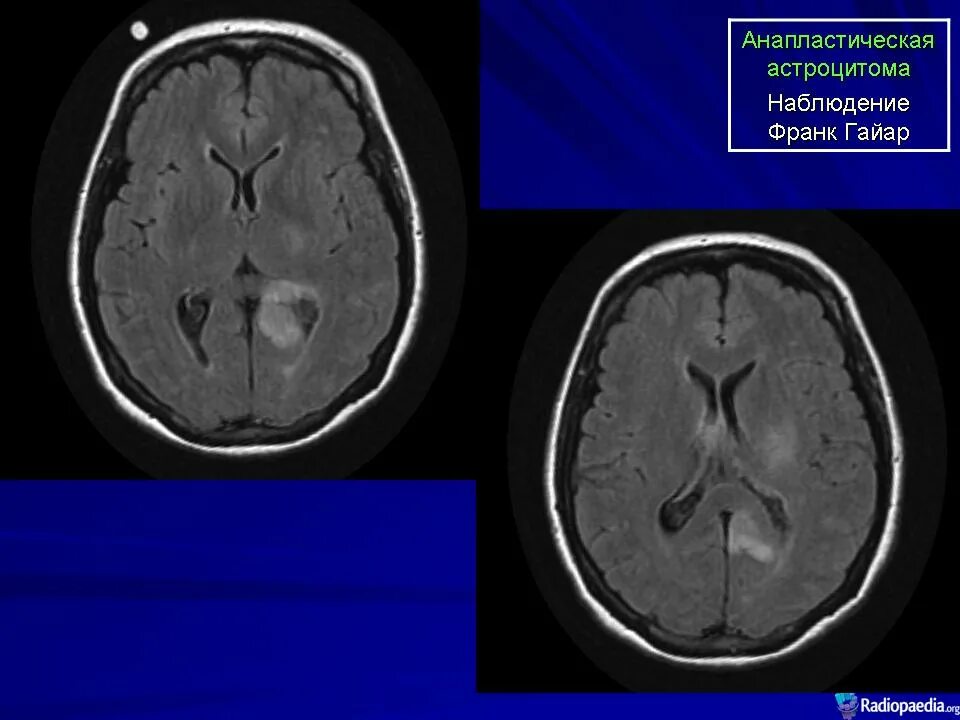 Астроцитома головного мозга прогноз. Анапластическая астроцитома кт. Мозжечковая астроцитома. Анапластическая злокачественная астроцитома гистология.