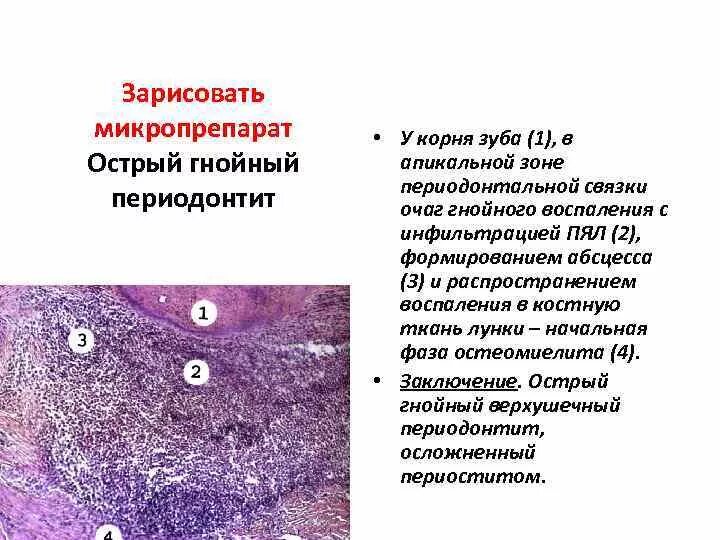 Очаг Гнойного воспаления микропрепарат. Микропрепараты патанатомия описание. Хронический Гнойный периодонтит препарат патанатомия. Гнойный характеристика