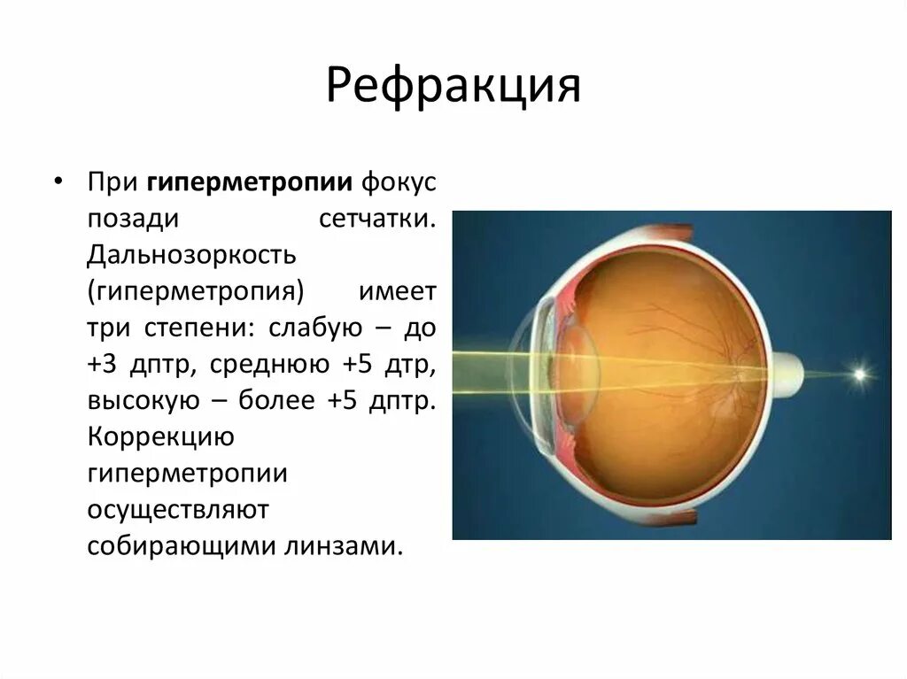 Гиперметропия средней степени глаза. Клинические проявления гиперметропии. Дальнозоркость дптр. Дальнозоркость высокой степени. Рефракция сетчатки глаза.