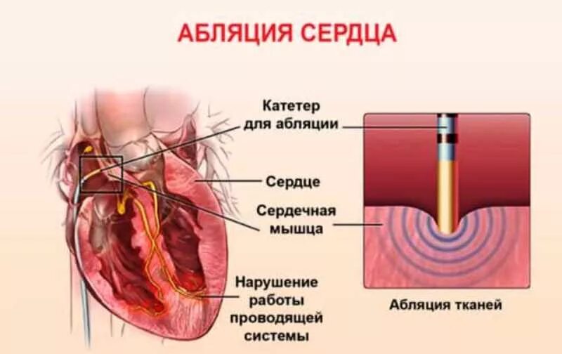 Рча предсердий. Высокочастотная абляция сердца. Аритмия сердца операция прижигание. Радиочастотная катетерная абляция (РЧА). Катетерная абляция сердца что это такое.