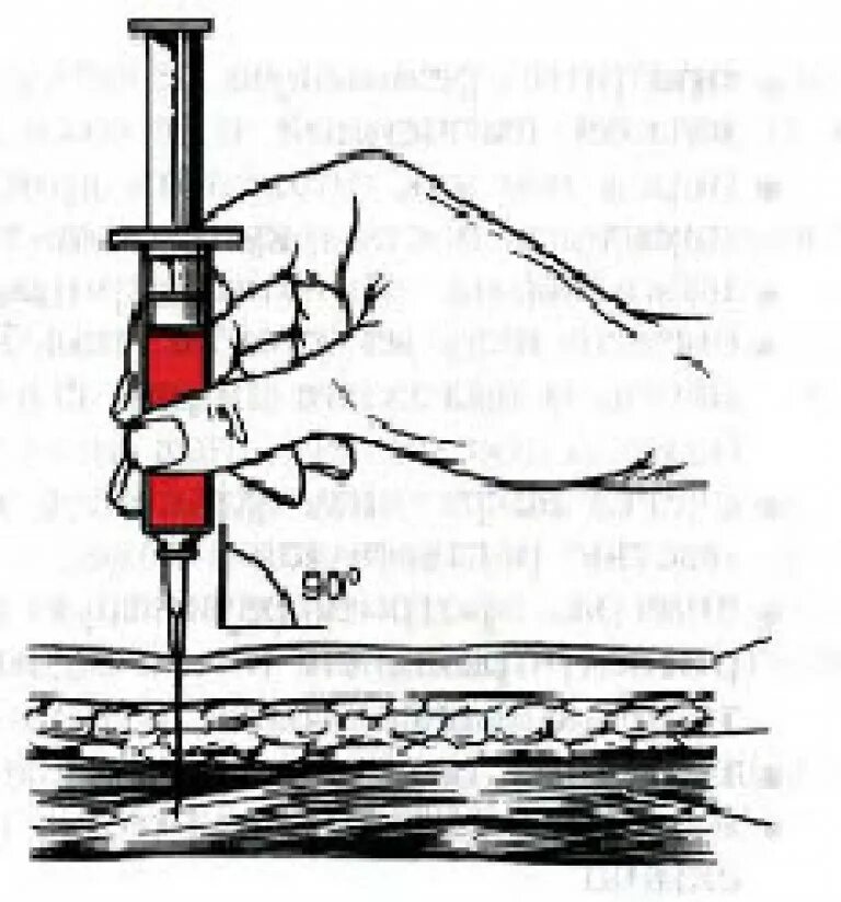 Как правильно держать шприц. Внутримышечная инъекция угол введения иглы. Техника введения внутримышечной инъекции в ягодицу. Введение иглы при внутримышечной инъекции. Игла для внутримышечных инъекций вводится.