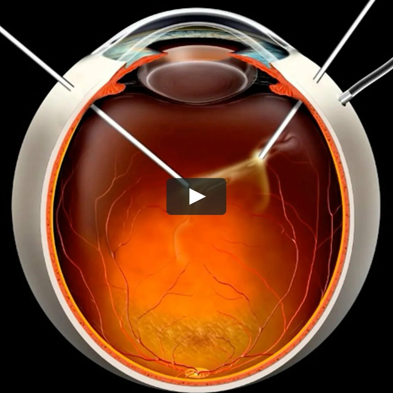 Отслойка сетчатки витрэктомия. Витрэктомия ретинопатия. Витрэктомия при диабетической ретинопатии. Отслойка сетчатки зрение глаза. Замена сетчатки