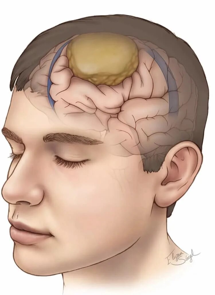 Киста в мозгах последствия. Злокачественное новообразование головного мозга. Доброкачественная опухоль мозга.