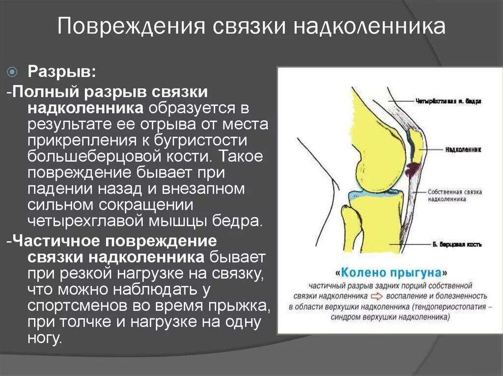 Частичный отрыв. Подвывих надколенника коленного сустава. отрыв медиального удерживателя надколенника. разрыв собственной связки надколенника рентген. повреждение медиального удерживателя надколенника 2 степени.