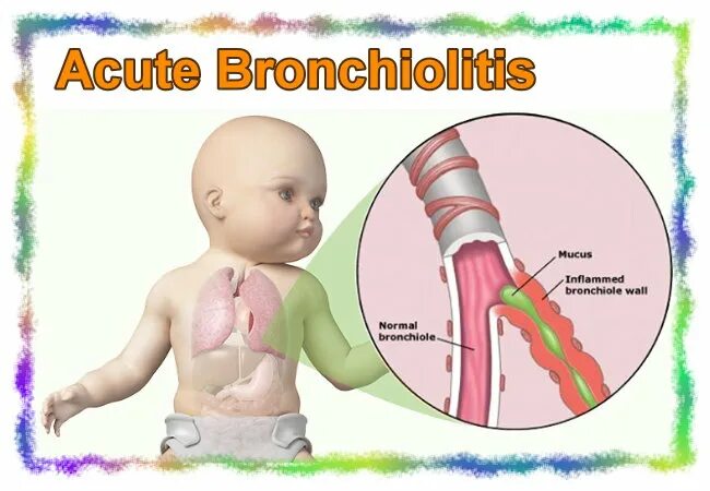 Бронхиты у грудных детей. Гнойно обструктивный бронхит. Гнойный бронхит симптомы.